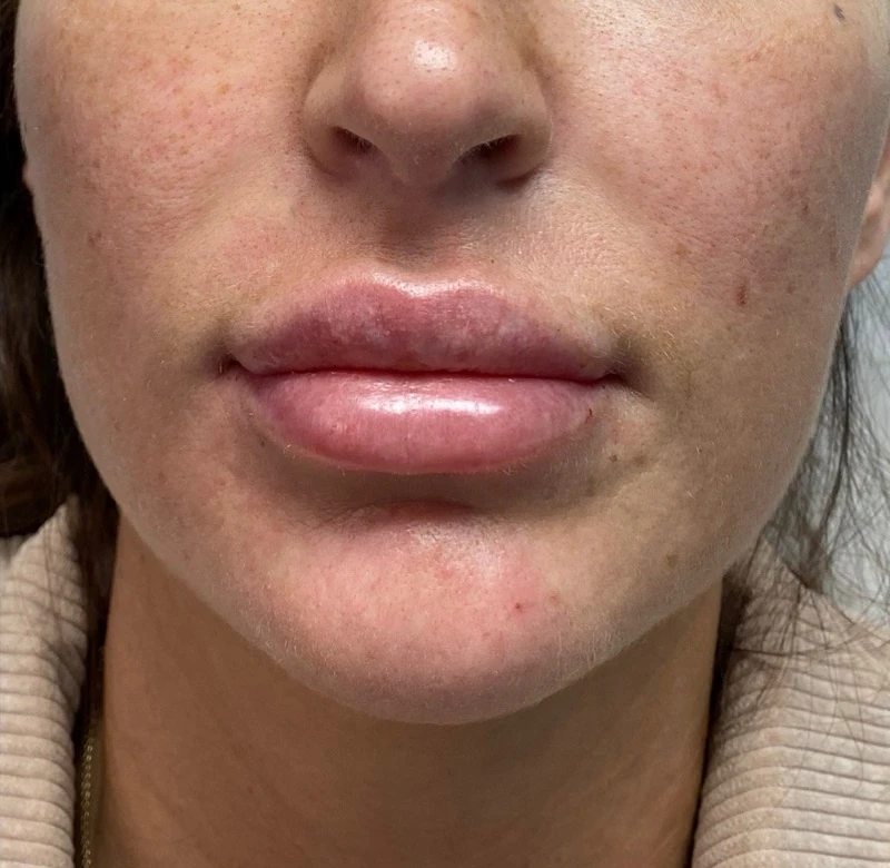 After: Fullness that stays in balance