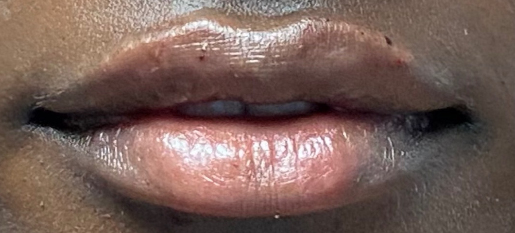 After: Fullness across both lips