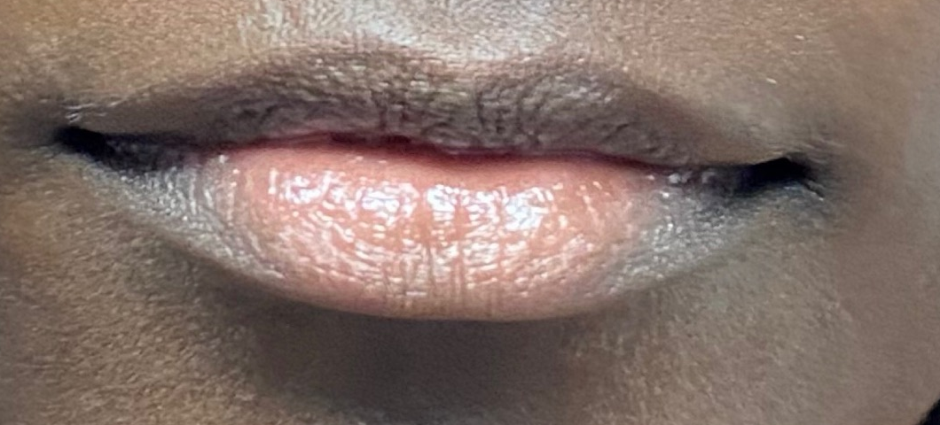 Before: Fullness across both lips