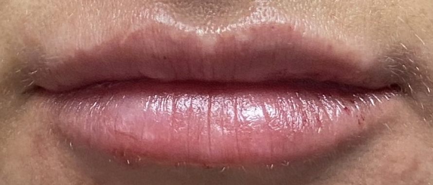 After: Contour, volume, hydration.