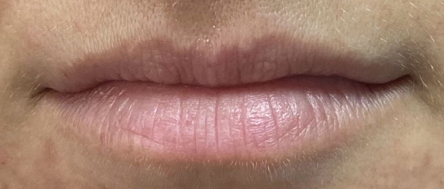 Before: Contour, volume, hydration.