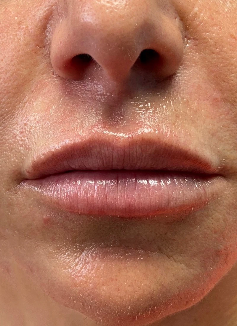 After: A smoother, fuller outline