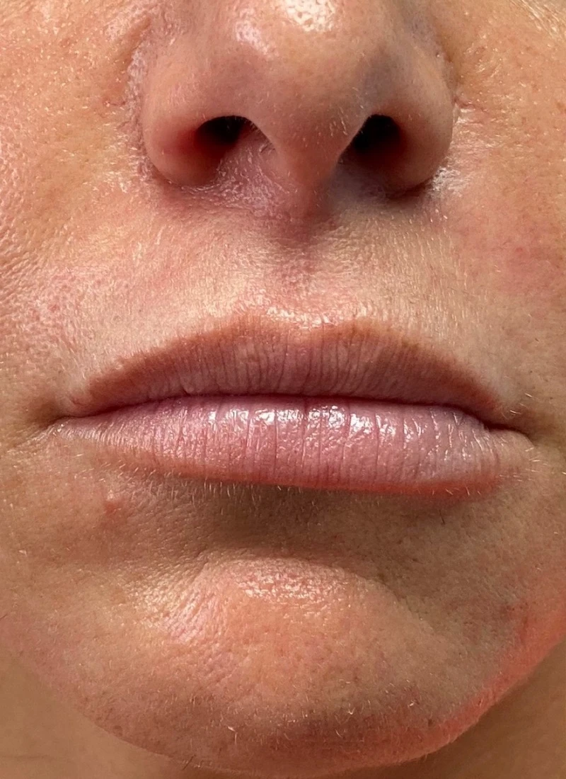 Before: A smoother, fuller outline