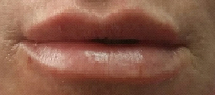 After: Correction after Bell’s palsy